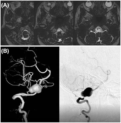 Microsurgical Treatment Strategy of Vertebral Artery Fusiform Aneurysm—From the Standpoint of Hemodynamic Integrity and Perforator Preservation